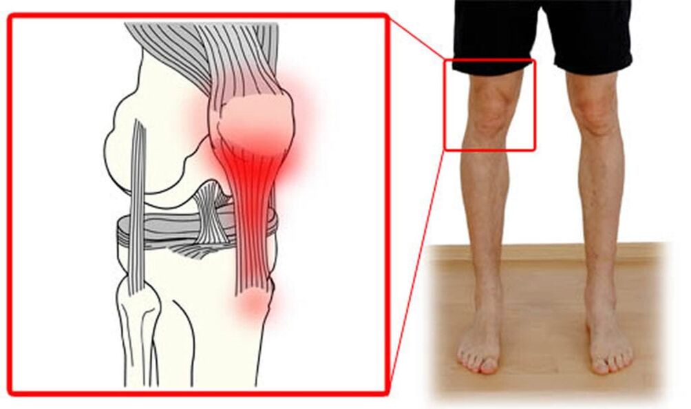 Tendinitis Entzündung der Sehnen des Kniegelenks.