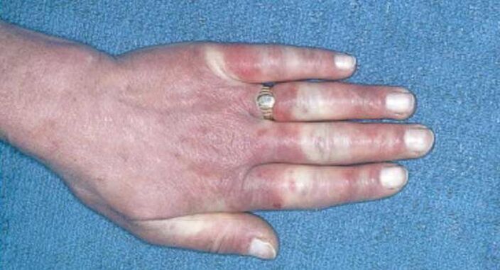 Klinisches Bild des Raynaud-Syndroms, Vasospasmus, Hyperämie, Ödem.