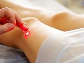 Behandlung von Kniegelenks -Osteoarthritis mit einem Laser